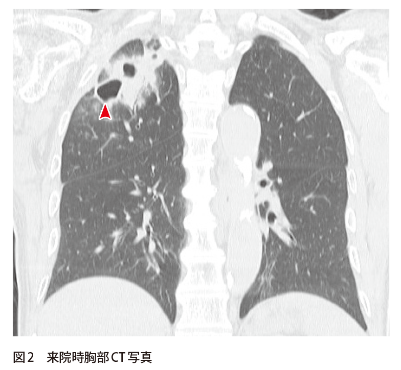 解答 解説 微熱 全身倦怠感を主訴として来院した70歳代男性 実践 画像診断q A 羊土社 レジデントノート 羊土社