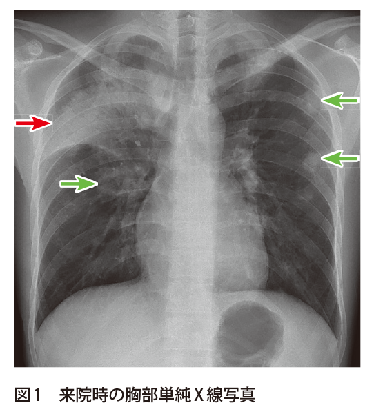 解答 解説 咳嗽 血痰を主訴に受診した20歳代男性 実践 画像診断q A 羊土社 レジデントノート 羊土社