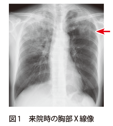 解答 解説 慢性咳嗽と発熱を主訴に受診した50歳代女性 実践 画像診断q A 羊土社 レジデントノート 羊土社
