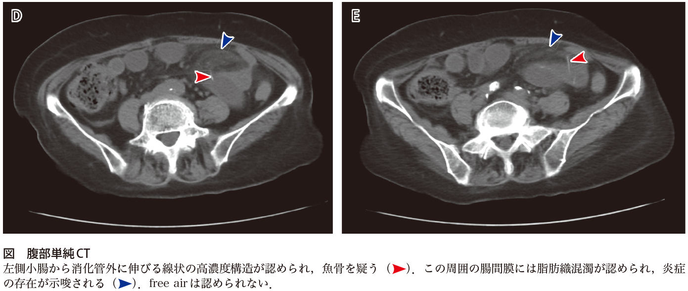 解答 解説 発熱と腹痛で来院した80歳代女性 実践 画像診断q A 羊土社 レジデントノート 羊土社