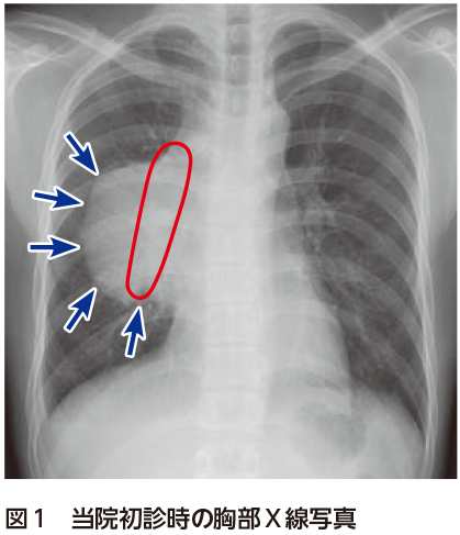 解答 解説 微熱 倦怠感 吸気時の胸痛を主訴に受診した歳代男性 実践 画像診断q A 羊土社 レジデントノート 羊土社