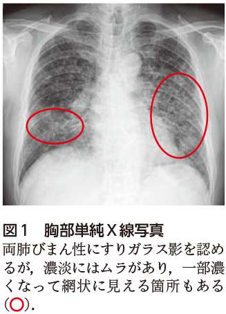 解答 解説 乾性咳嗽 微熱 労作時呼吸困難で受診した60歳代男性 実践 画像診断q A 羊土社 レジデントノート 羊土社