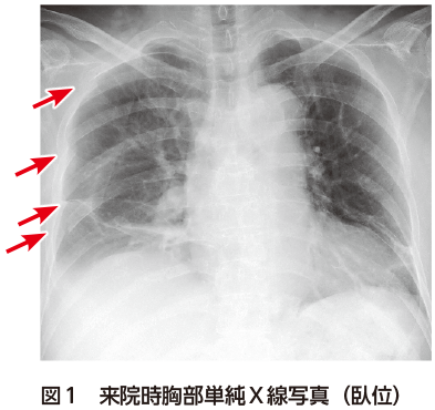 解答 解説 背部痛 呼吸困難を主訴に来院した50歳代女性 実践 画像診断q A 羊土社 レジデントノート 羊土社