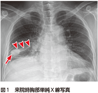 解答 解説 右背部 右側腹部 右肩の疼痛を主訴に受診した50歳代男性 実践 画像診断q A 羊土社 レジデントノート 羊土社