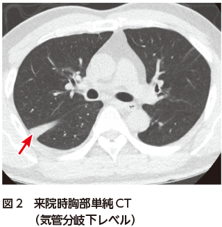 解答 解説 右背部 右側腹部 右肩の疼痛を主訴に受診した50歳代男性 実践 画像診断q A 羊土社 レジデントノート 羊土社