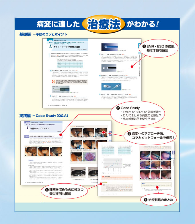 症例で身につける消化器内視鏡シリーズ　病変に適した治療法がわかる！