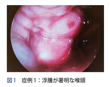 図 症例 1:浮腫が著明な喉頭