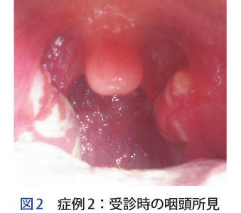 図 症例 2:受診時の咽頭所見