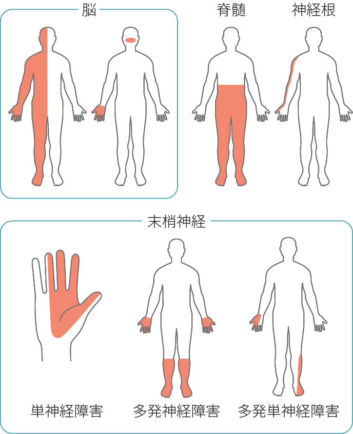 図4　神経障害性疼痛の分布による分類