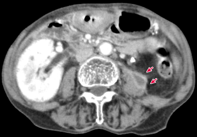 図2　症例の腹部造影CT