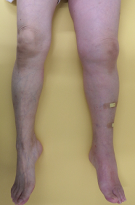 図2　症例の下肢の写真