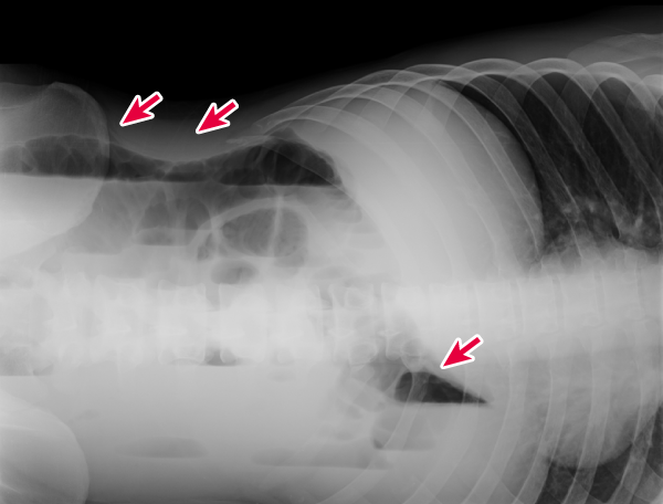 図1：症例1（Aさんの腹部単純X線画像（左側臥位）