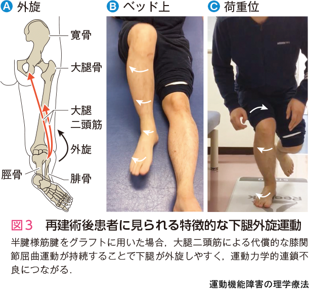 図3 再建術後患者に見られる特徴的な下腿外旋運動