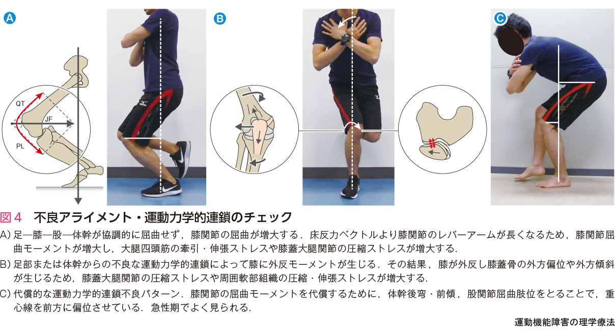 図4 不良アライメント・運動力学的連鎖のチェック