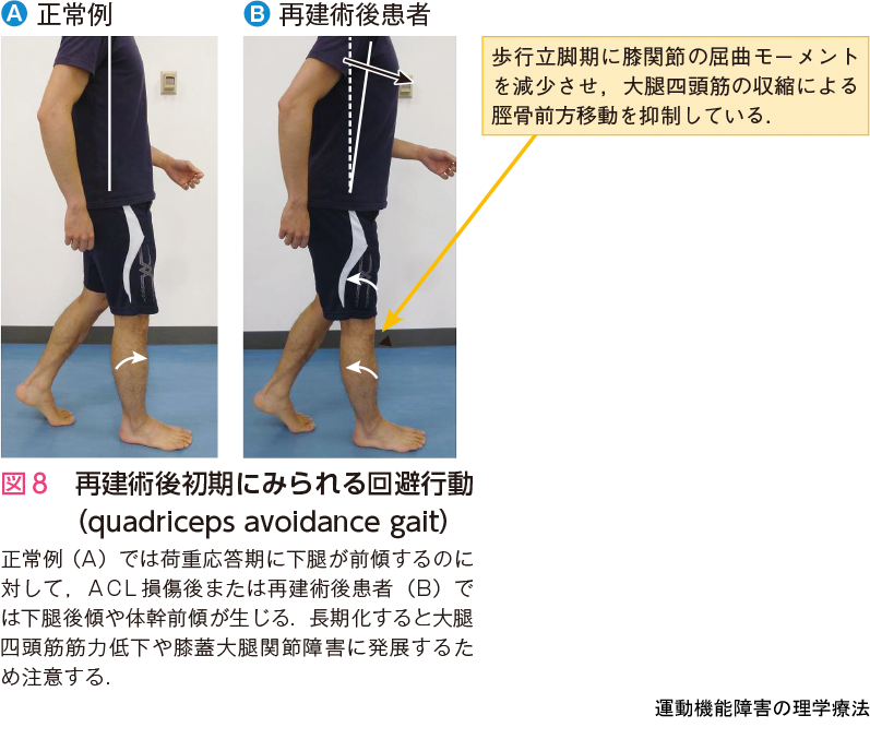 図8 再建術後初期にみられる回避行動 (quadriceps avoidance gait)