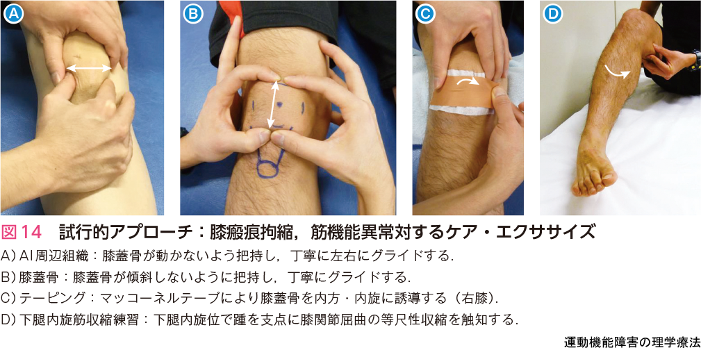 図14 試行的アプローチ:膝瘢痕拘縮，筋機能異常対するケア・エクササイズ