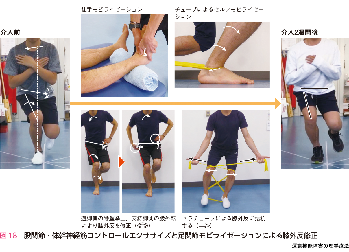 図18 股関節・体幹神経筋コントロールエクササイズと足関節モビライゼーションによる膝外反修正