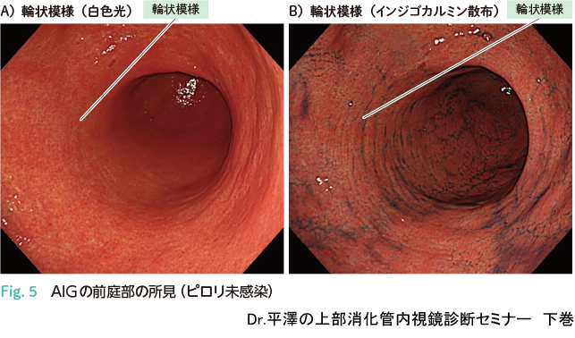 Dr.平澤の上部消化管内視鏡診断セミナー 下巻〜がんを見逃さないための 