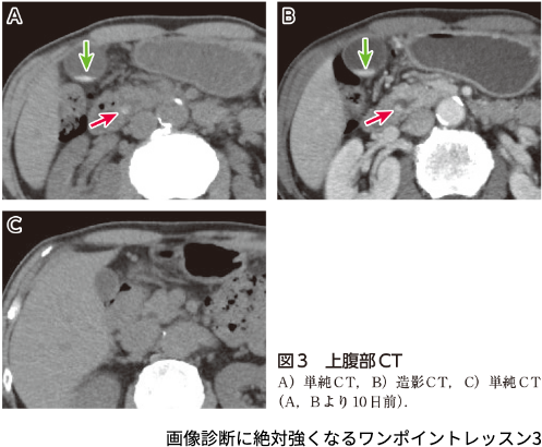 図3　上腹部CT