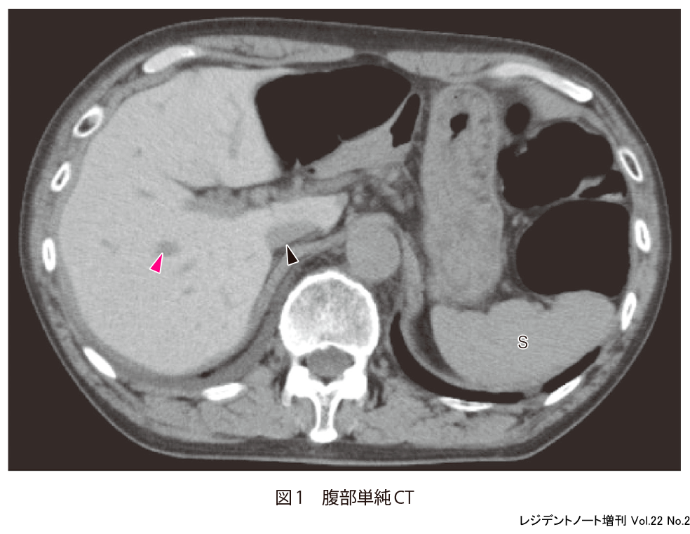 図1　腹部単純CT