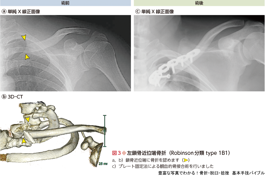 豊富な写真でわかる 骨折 脱臼 捻挫 基本手技バイブル 羊土社