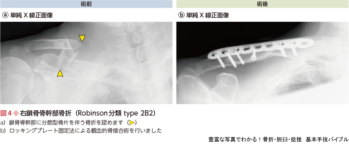 豊富な写真でわかる 骨折 脱臼 捻挫 基本手技バイブル 羊土社