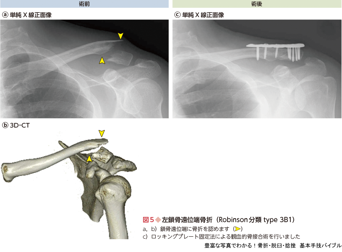 豊富な写真でわかる 骨折 脱臼 捻挫 基本手技バイブル 羊土社