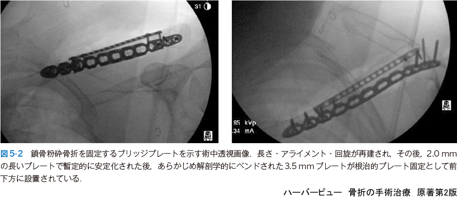 ハーバービュー 骨折の手術治療 原著第2版 羊土社