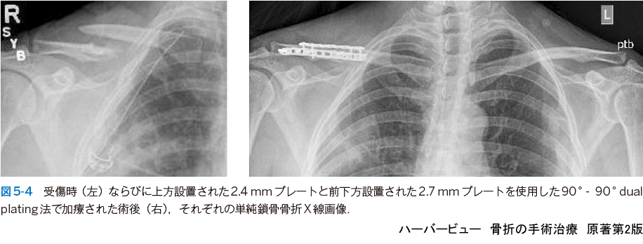 ハーバービュー 骨折の手術治療 原著第2版 羊土社