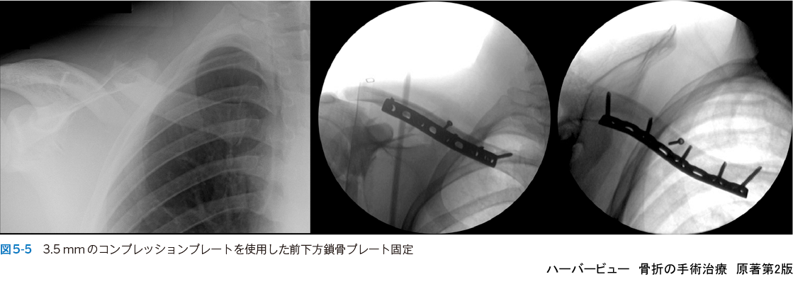 ハーバービュー 骨折の手術治療 原著第2版 羊土社