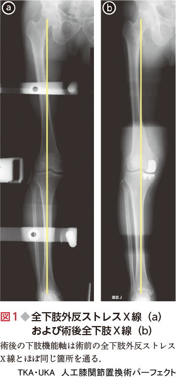 TKA・UKA 人工膝関節置換術パーフェクト〜人工膝関節全置換術・人工膝 