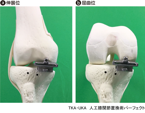 TKA・UKA 人工膝関節置換術パーフェクト〜人工膝関節全置換術・人工膝関節単顆置換術の基本とコツ - 羊土社