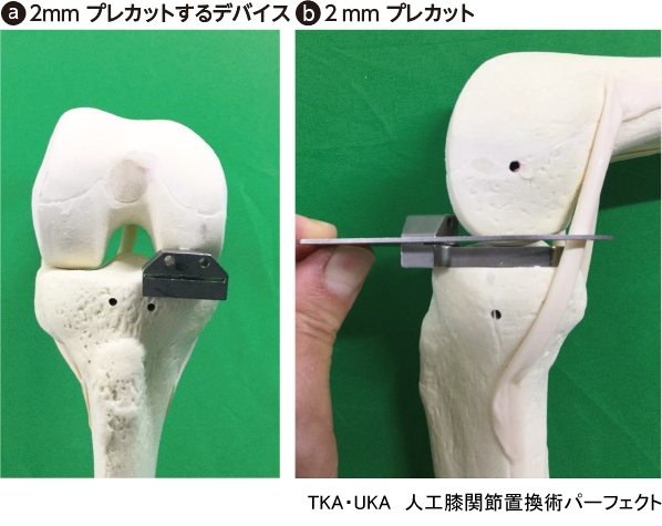 大腿骨後顆部のプレカット