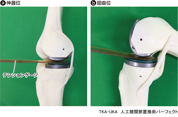 TKA・UKA 人工膝関節置換術パーフェクト〜人工膝関節全置換術・人工膝関節単顆置換術の基本とコツ - 羊土社