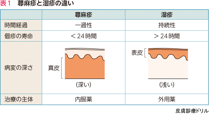 蕁麻疹の治療法は何ですか?